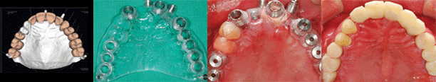 Dental Implant_image 5