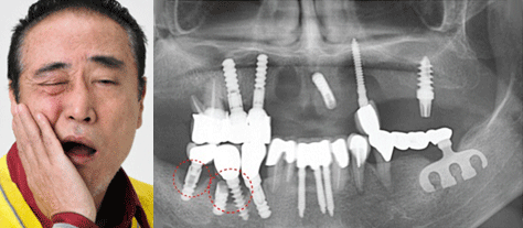 Dental Implant_image 9