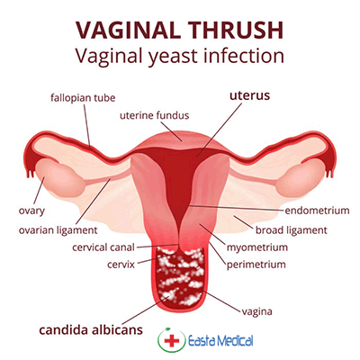 vaginal-yeast-infection surgery